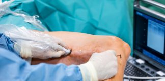 Operația de varice: ce trebuie să știi despre recuperare și rezultate